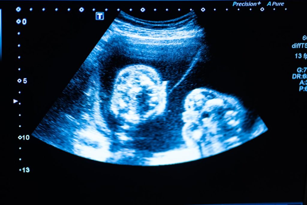 échographie suivi de grossesse