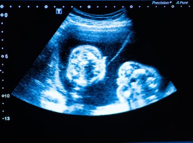 Elle porte un foetus calcifié pendant 9 ans et meurt de malnutrition