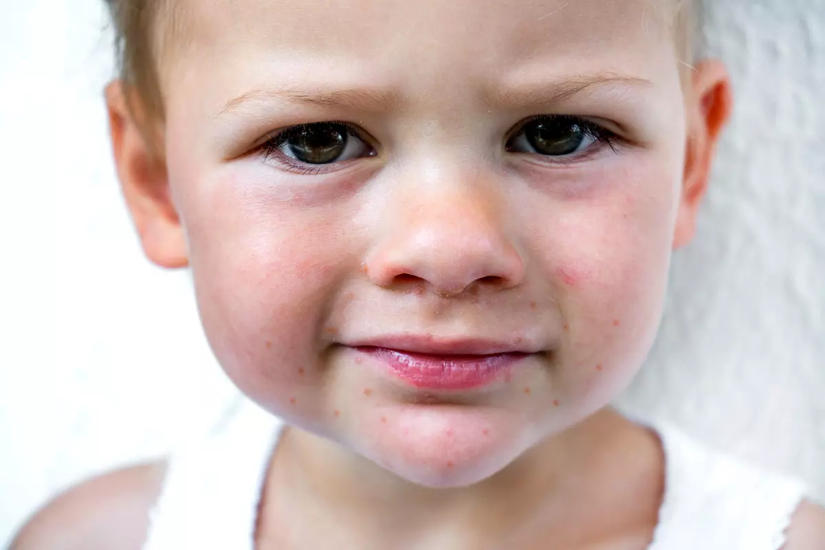 Santé des enfants : les éruptions cutanées et leurs multiples causes